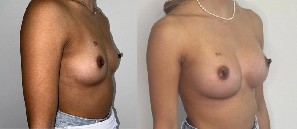 Real Patient Results in New South Wales, Australia Performed by Dr. Anthony Barker