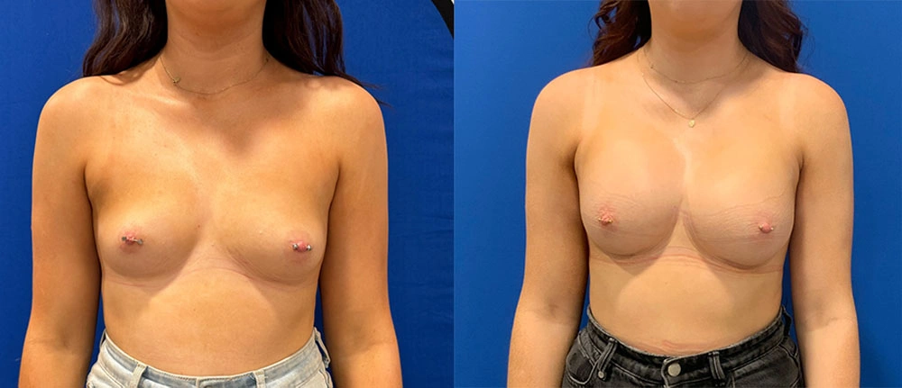 Real Patient Results in New South Wales, Australia Performed by Dr. Anthony Barker