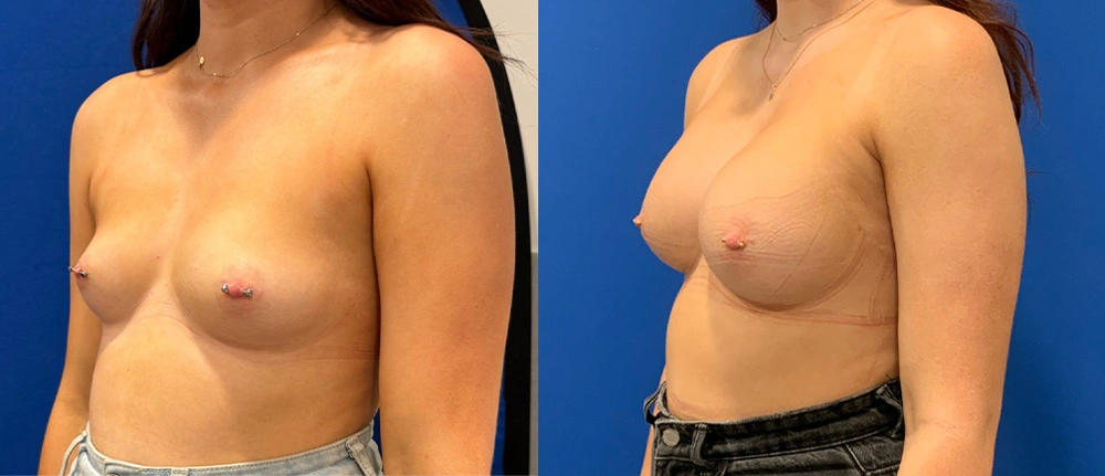 Real Patient Results in New South Wales, Australia Performed by Dr. Anthony Barker
