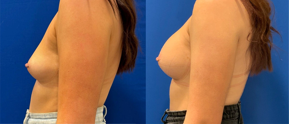 Real Patient Results in New South Wales, Australia Performed by Dr. Anthony Barker