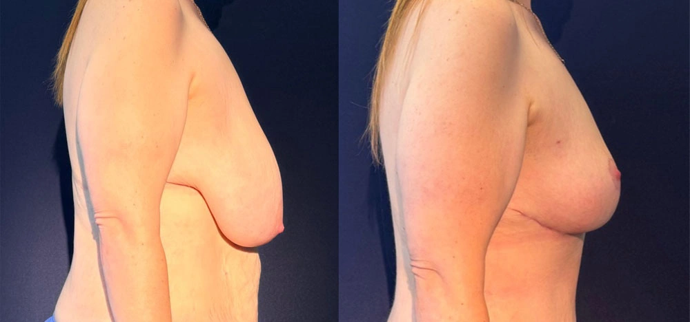 Real Patient Results in New South Wales, Australia Performed by Dr. Anthony Barker