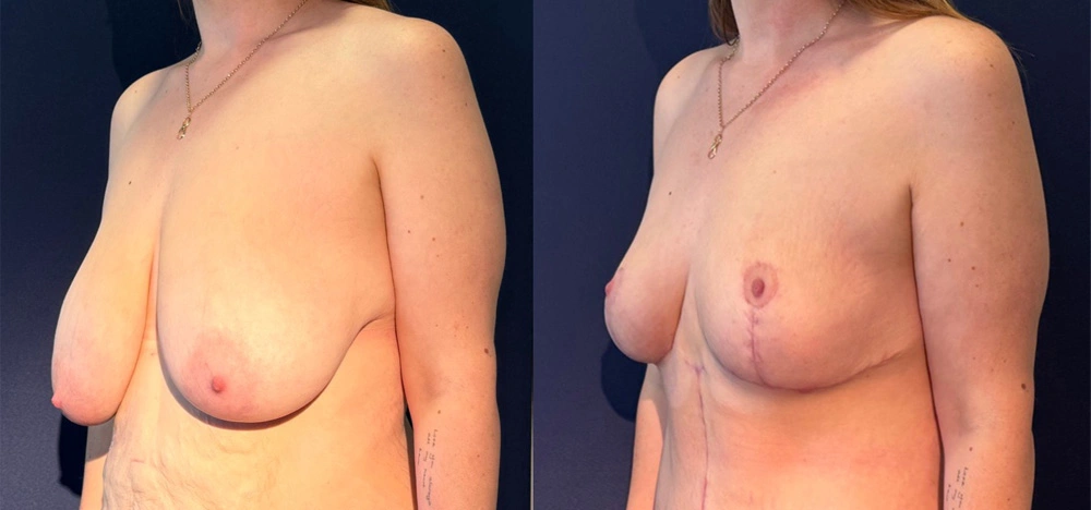 Real Patient Results in New South Wales, Australia Performed by Dr. Anthony Barker