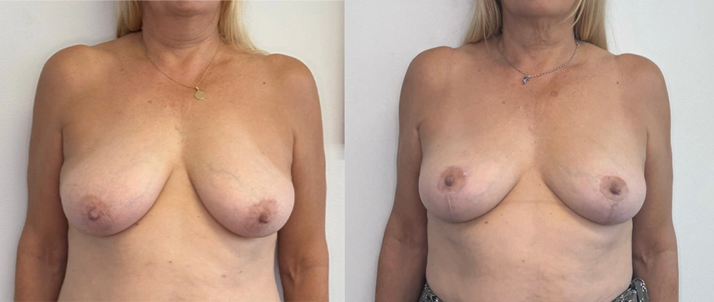 Real Patient Results in New South Wales, Australia Performed by Dr. Anthony Barker