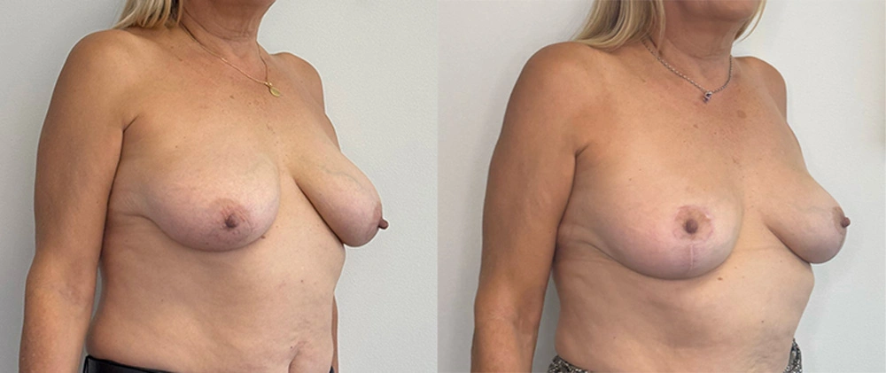 Real Patient Results in New South Wales, Australia Performed by Dr. Anthony Barker