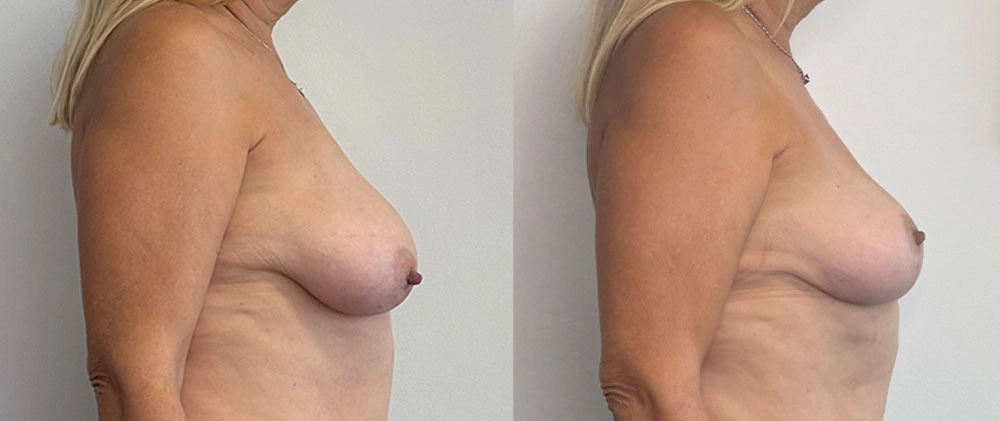 Real Patient Results in New South Wales, Australia Performed by Dr. Anthony Barker