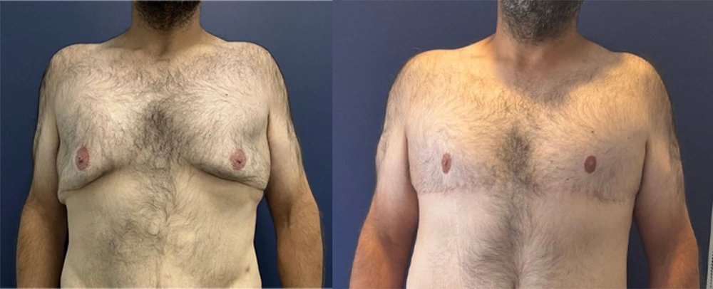 Real Patient Results in New South Wales, Australia Performed by Dr. Anthony Barker