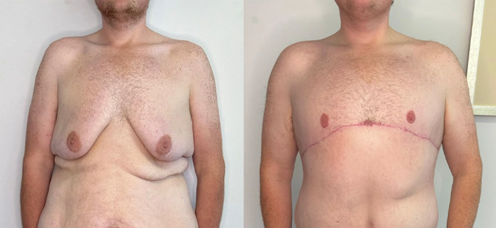 Real Patient Results in New South Wales, Australia Performed by Dr. Anthony Barker