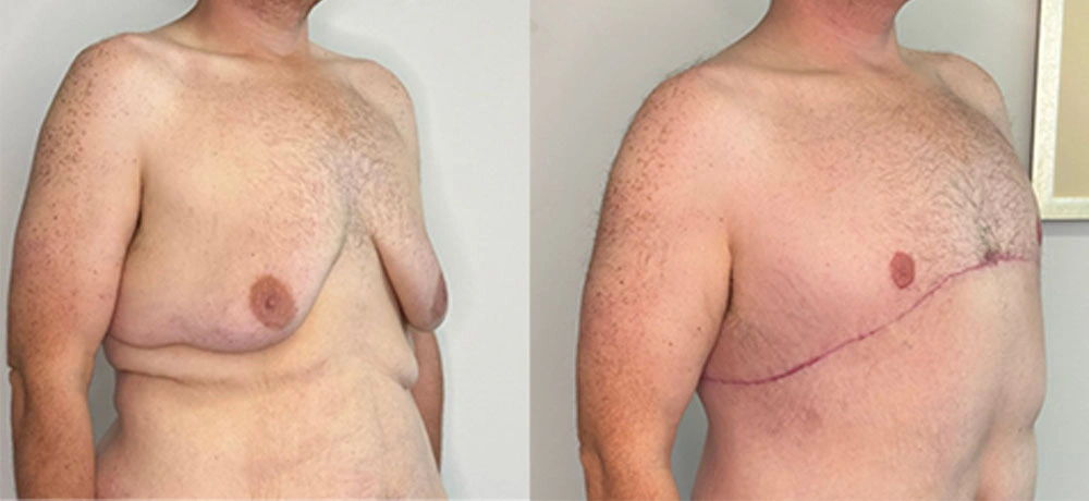 Real Patient Results in New South Wales, Australia Performed by Dr. Anthony Barker