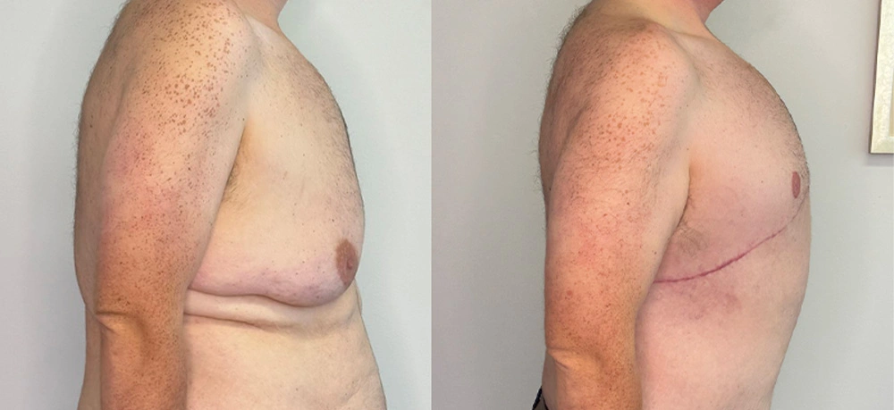 Real Patient Results in New South Wales, Australia Performed by Dr. Anthony Barker