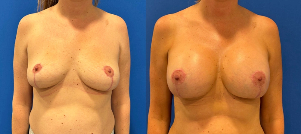 Real Patient Results in New South Wales, Australia Performed by Dr. Anthony Barker