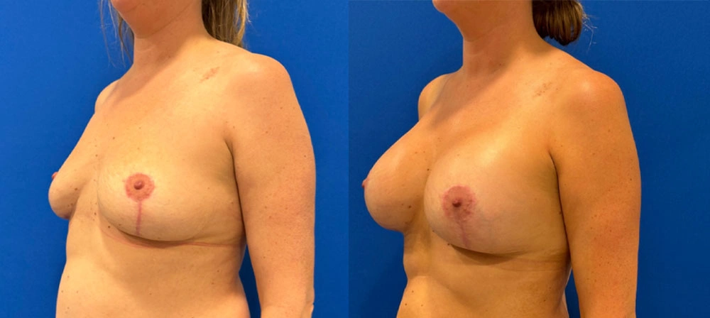Real Patient Results in New South Wales, Australia Performed by Dr. Anthony Barker
