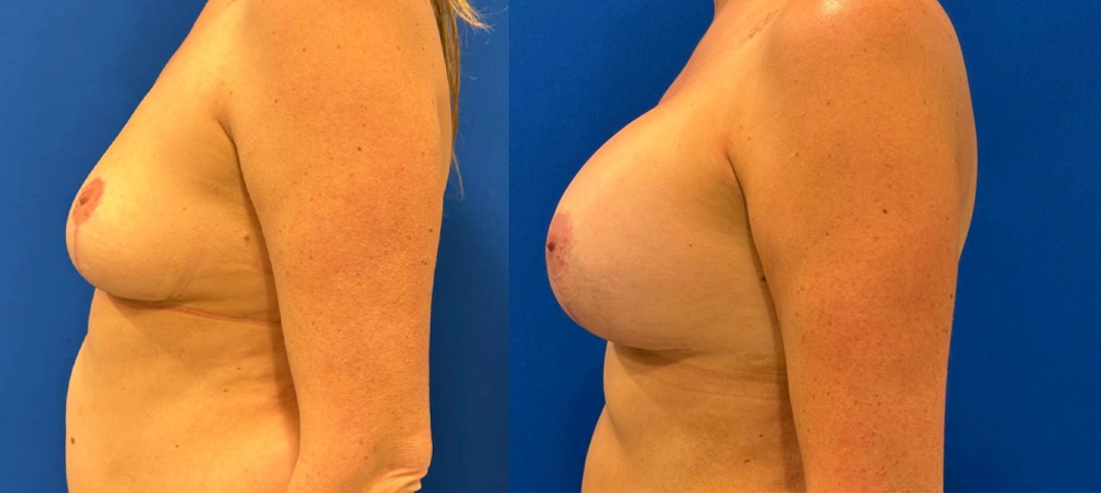 Real Patient Results in New South Wales, Australia Performed by Dr. Anthony Barker