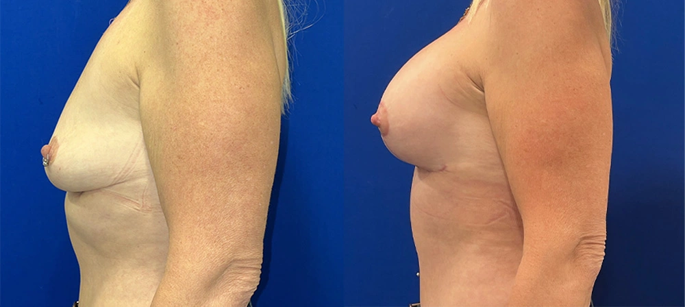 Real Patient Results in New South Wales, Australia Performed by Dr. Anthony Barker