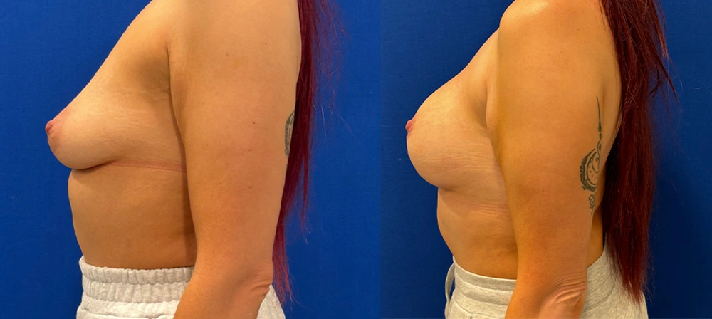 Real Patient Results in New South Wales, Australia Performed by Dr. Anthony Barker