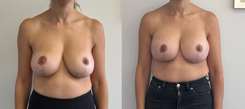 Real Patient Results in New South Wales, Australia Performed by Dr. Anthony Barker