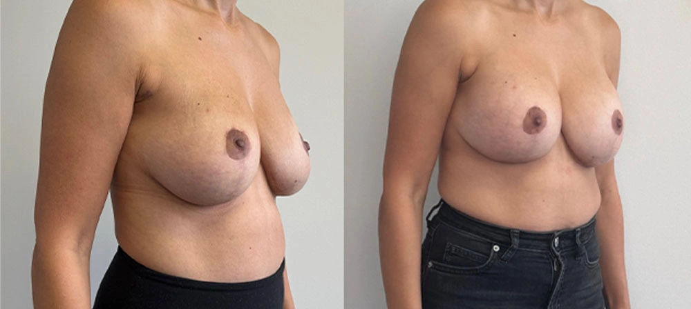 Real Patient Results in New South Wales, Australia Performed by Dr. Anthony Barker