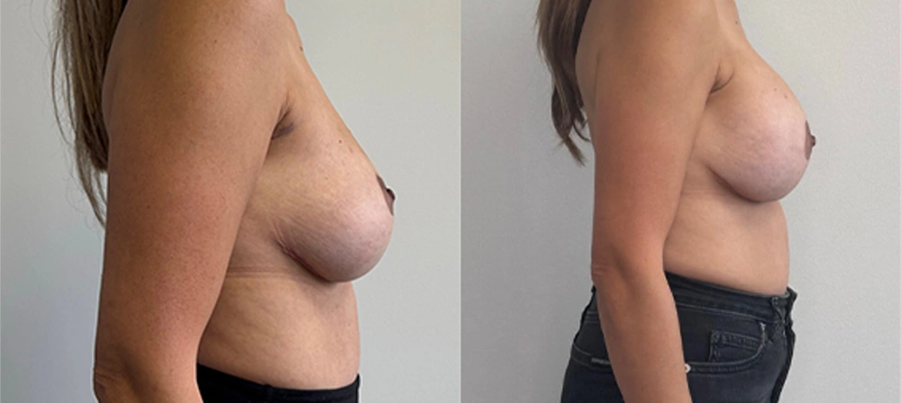Real Patient Results in New South Wales, Australia Performed by Dr. Anthony Barker