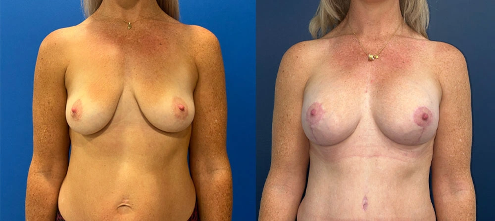 Real Patient Results in New South Wales, Australia Performed by Dr. Anthony Barker