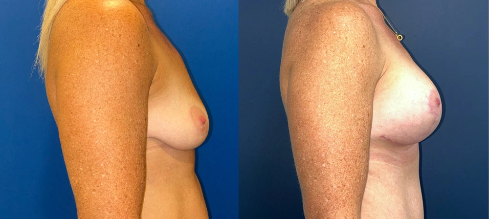Real Patient Results in New South Wales, Australia Performed by Dr. Anthony Barker