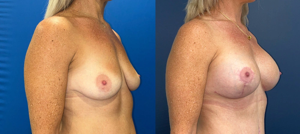 Real Patient Results in New South Wales, Australia Performed by Dr. Anthony Barker