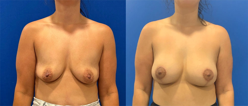 Real Patient Results in New South Wales, Australia Performed by Dr. Anthony Barker