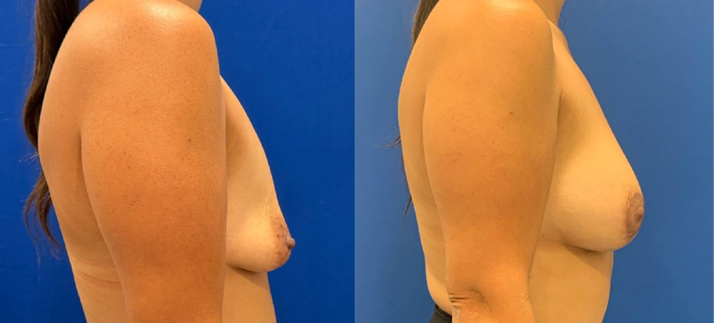 Real Patient Results in New South Wales, Australia Performed by Dr. Anthony Barker