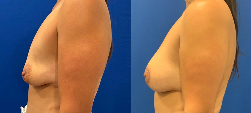 Real Patient Results in New South Wales, Australia Performed by Dr. Anthony Barker
