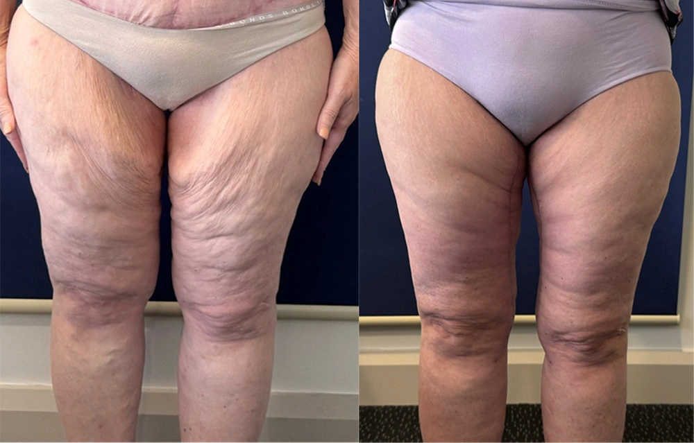 Real Patient Results in New South Wales, Australia Performed by Dr. Anthony Barker