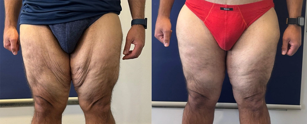 Real Patient Results in New South Wales, Australia Performed by Dr. Anthony Barker