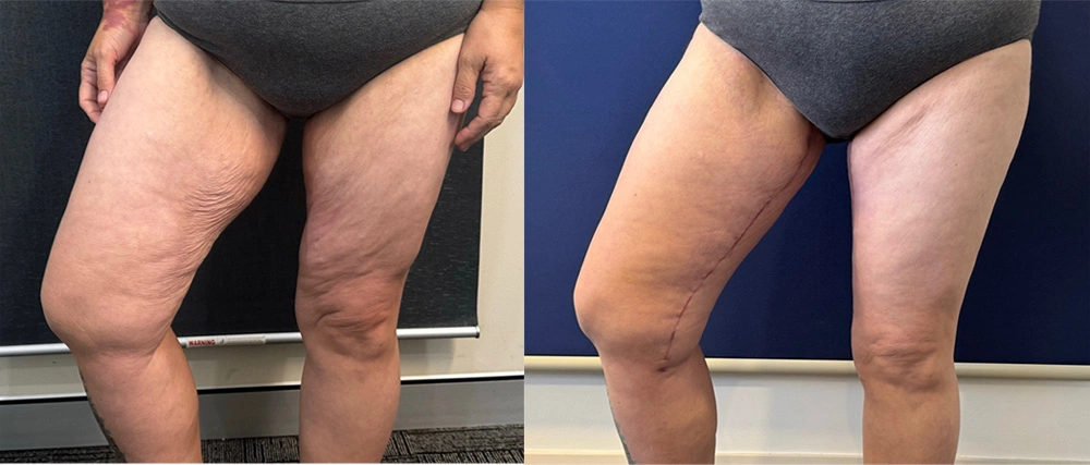 Real Patient Results in New South Wales, Australia Performed by Dr. Anthony Barker