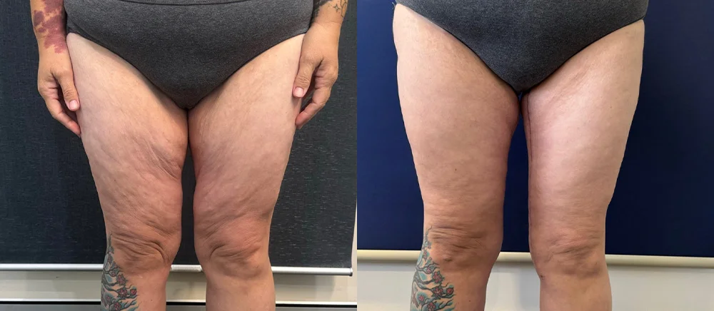 thighlift new 1-1