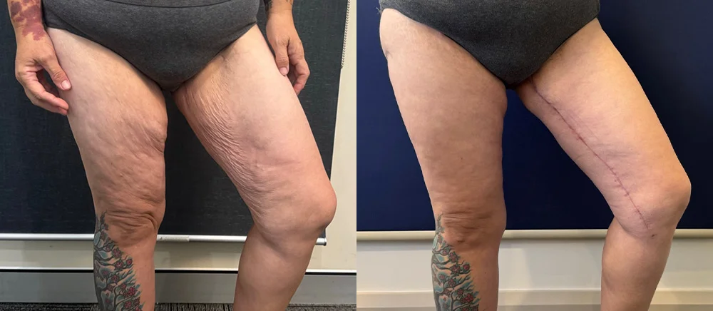 thighlift new 1-2