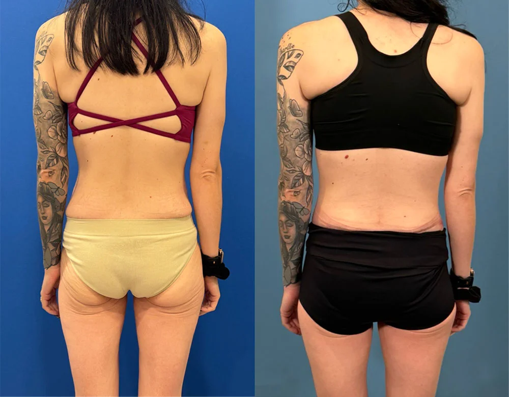 POST OP 270 ABDOMINOPLASTY BACK_