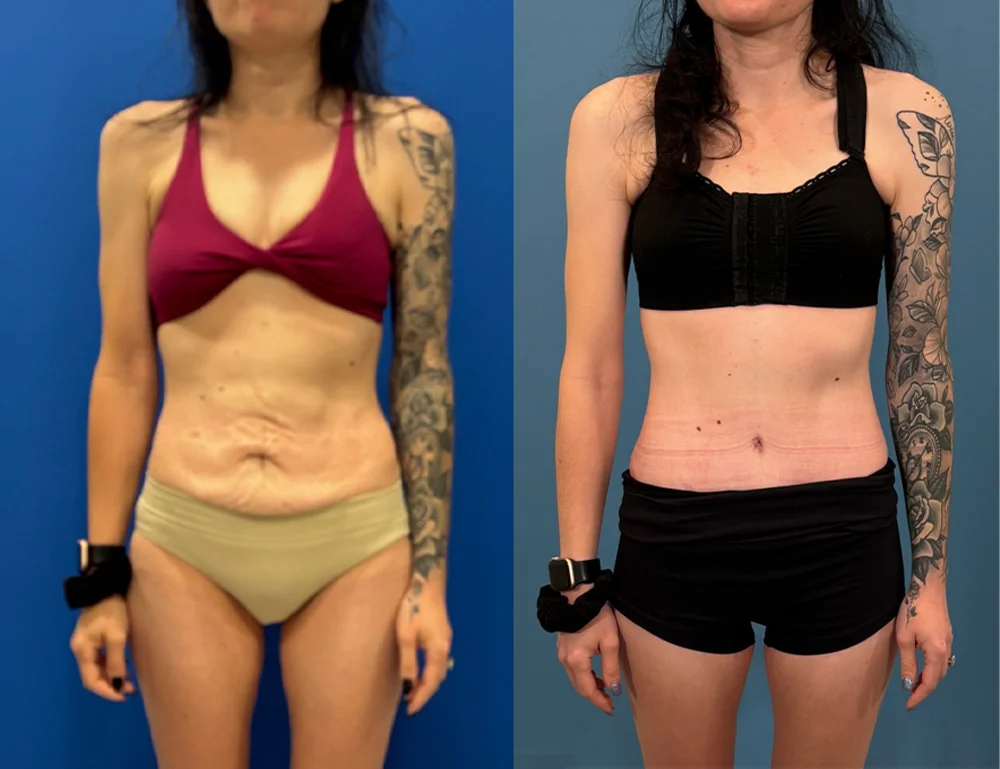 POST OP 270 ABDOMINOPLASTY FRONT_